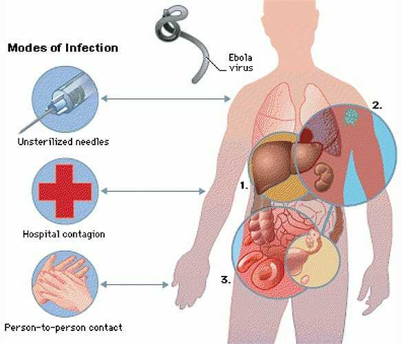 Tránh mọi tiếp xúc với người mắc bệnh, cần theo dõi xem có thấy các triệu chứng của bệnh và đến ngay cơ sở y tế nếu thấy xuất hiện các dấu hiệu bệnh đầu tiên.