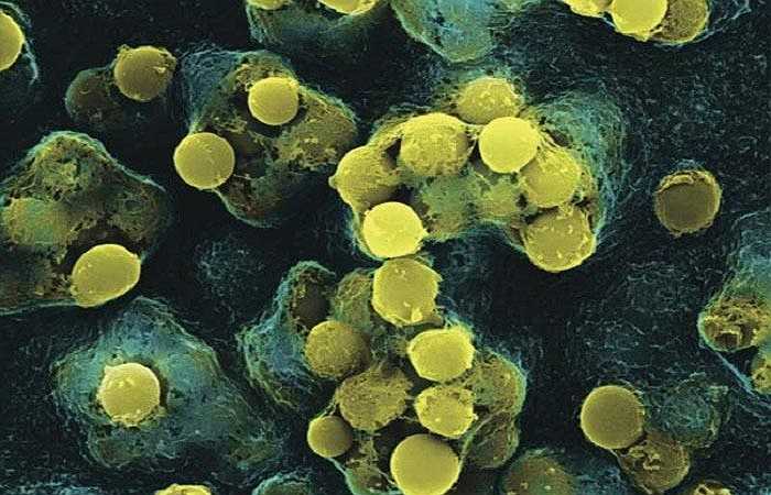 Các nhà nghiên cứu của Bệnh viện Methodist ở Texas cho biết, loại vi khuẩn có tên gọi là nhóm A Streptococcus (thường xuất hiện ở những bệnh nhân có phần cơ thể bị nhiễm trùng) đã trải qua bốn sự thay đổi di truyền lớn trong quá trình chuyển thành dạng vi khuẩn gây hoại tử cơ thể.