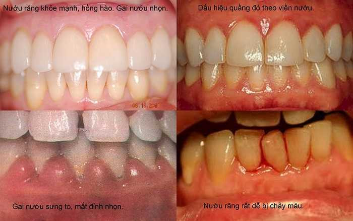 Viêm nướu, do vôi răng nhiều, đây chính là nơi vi khuẩn trú ngụ và gây ra hôi miệng. Viêm nha chu, đây là bệnh viêm nướu diễn tiến nặng do không điều trị