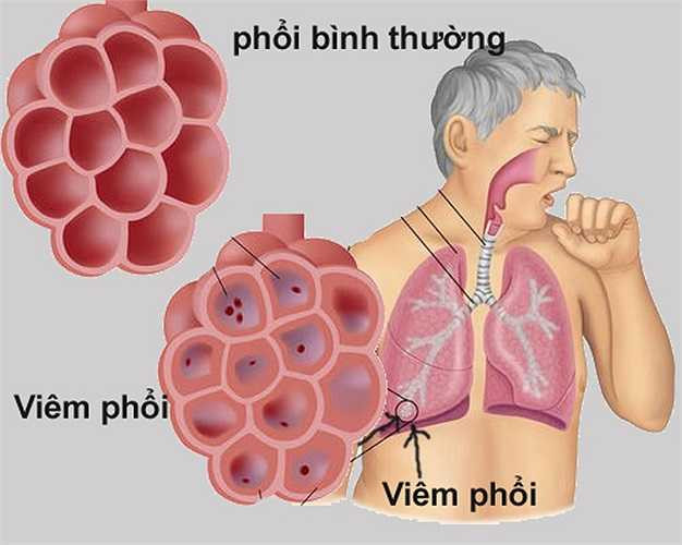 Mùi hôi còn có thể do các bệnh về phổi cấp tính và mãn tính. Trong số đó có thể kể đến bệnh viêm thanh quản, viêm khí quản, viêm phổi, áp xe phổi và một số bệnh khác.