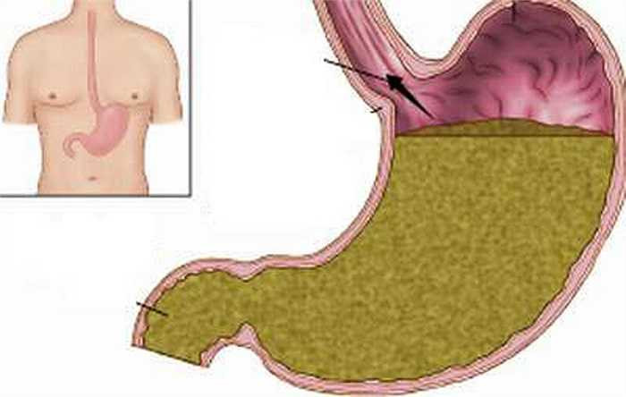 Người bị bệnh trào ngược dạ dày thực quản cũng gây ra hôi miệng vì van đóng thực quản và dạ dày (bao tử) bị lỏng lẻo, không còn khả năng ngăn chặn các mùi khó chịu từ hệ tiêu hóa bay lên miệng. 