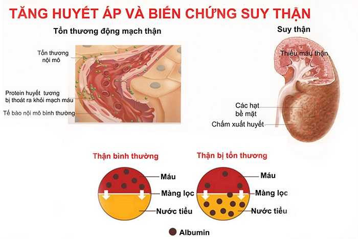Bệnh suy thận mãn tính lại khiến hơi thở có mùi cá ươn. Vai trò của thận là loại bỏ chất thải từ máu, khi thận gặp vấn đề nó không thể loại bỏ tất cả các độc tố ra khỏi máu. 