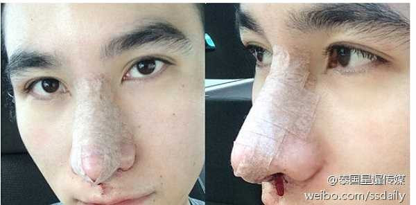 Chàng trai người Thái chính là một sản phẩm của công nghệ dao kéo. Bản thân anh cũng thừa nhận mình từng trải qua một số ca phẫu thuật thẩm mỹ và may mắn thành công, đạt kết quả như mong muốn.