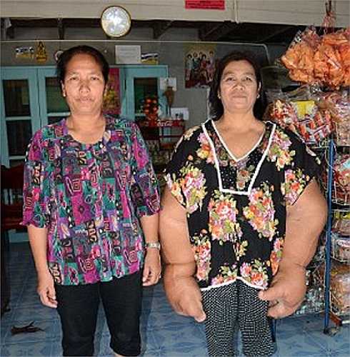 'Các bác sỹ bảo rằng cách duy nhất để chữa trị tận gốc căn bệnh này là cắt bỏ đôi tay, nhưng tôi không thể làm thế, tôi cần phải làm việc' - Bác Samaksamam chia sẻ.