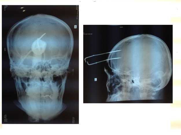Trộm chó bắn chĩa cắm giữa trán người đuổi bắt