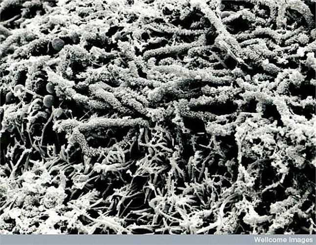 Mảng bám trên răng: Bạn phải chải răng thường xuyên vì đây là cái tạo thành trên bề mặt một chiếc răng - lớp mảng bám được tạo thành trông giống như đám dây rợ lằng nhằng vậy.