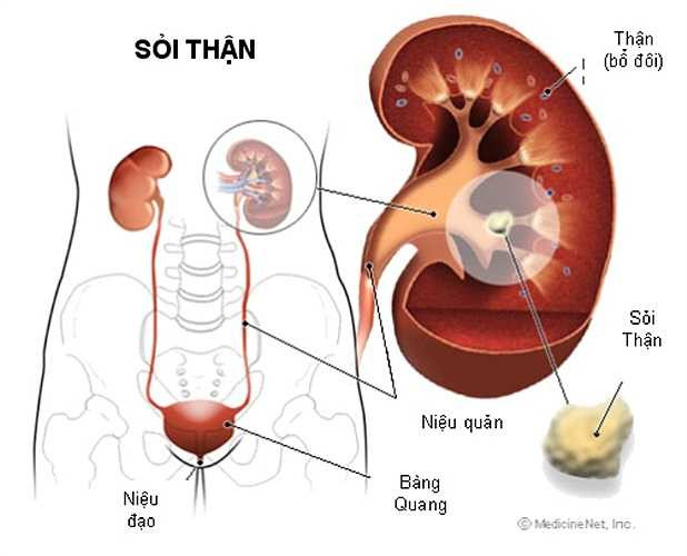 5. Sỏi thận: Khi sỏi thận bị đẩy xuống, nó có thể gây đau dữ dội cho tinh hoàn. Nhưng dù sao đau tinh hoàn do sỏi thận cũng là may mắn nhất. Nhiều người sẽ thở dài nhẹ nhõm vì tinh hoàn được an toàn. 
