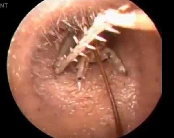 Bác sỹ Sweet đã phải thật khéo léo và thận trọng khi dùng nhíp lấy con dế ra khỏi tai bệnh nhân