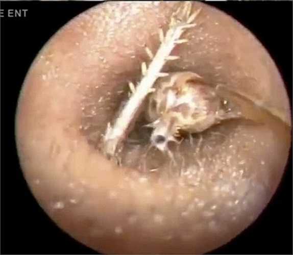 Ông chia sẻ: 'Tôi phải thật bình tĩnh khi kéo con dế ra khỏi tai bệnh nhân, nếu nhỡ tay, con dế có thể chạy sâu vào bên trong'.