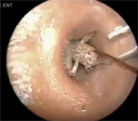 Các chuyên gia cho rằng con dế có thể đã chui vào tai khi người đàn ông đang ngủ.
