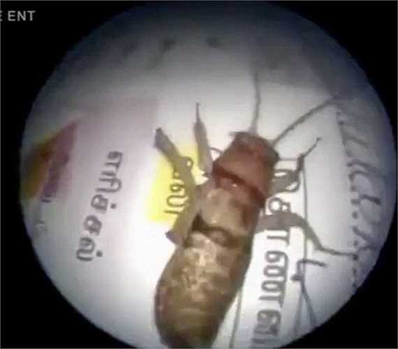 Hình ảnh con dế còn sống sau khi được lấy ra khỏi tai người đàn ông.