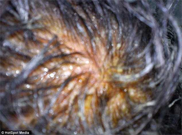 Hình ảnh phần đỉnh đầu của cô bị bỏng vì dị ứng thuốc nhuộm.