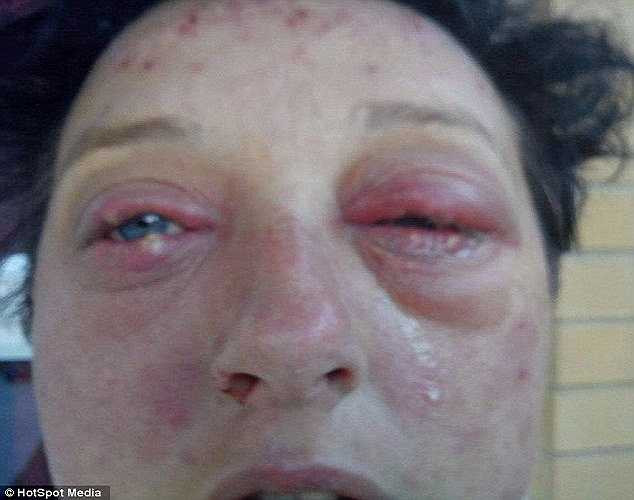 'Tôi không thể hiểu nổi tại sao tôi lại bị chứng dị ứng tồi tệ như thế này mặc dù tôi đã đọc và làm theo đúng chỉ dẫn trong giấy hướng dẫn sử dụng', cô Thomson nói.