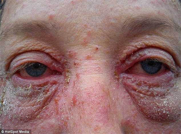 Sự việc khiến bà mẹ này chỉ dám ở trong nhà trong suốt hơn 1 tháng bị dị ứng trước khi tìm đến bệnh viện để điều trị.