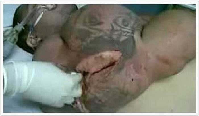 Một người đàn ông Braxin bị vỡ cơ bắp tay do lạm dụng synthol. Người đàn ông này đã chết trong bệnh viện sau đó. 