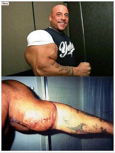 Greg Valentino đã nổi danh trên toàn thế giới với danh hiệu người đàn ông có cơ bắp lớn nhất thế. Sau đó, một cánh tay của Valentino đã bị gãy do tai nạn tại một giải đấu nhưng anh đã không đến viện và hậu quả là cánh tay của anh bị áp xe và buộc phải phẫu thuật.