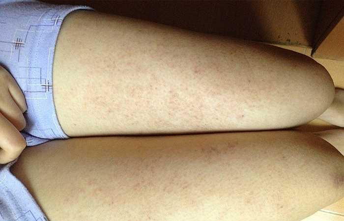 Viêm nang lông: Vi khuẩn hoặc nấm thâm nhập vào da thông qua lỗ chân lông khi da bí bách và bị quần áo chà xát nhiều, biểu hiện là lỗ chân lông bị mẩn đỏ. Nếu không chữa trị kịp thời, viêm nang lông sẽ phát triển thành nhiều mụn, nhọt, đinh râu...