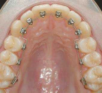 Sáng ngủ dậy tá hỏa phát hiện đã nuốt niềng răng