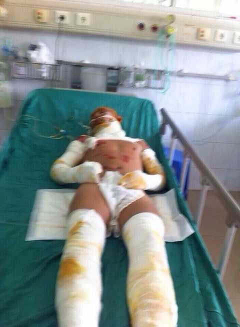 Dùng xăng tẩy vết bẩn, hai vợ chồng và con bị bốc cháy