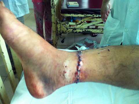 Không dám nhìn chân bị đứt lìa