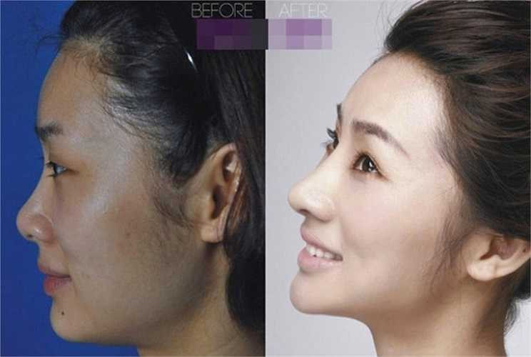 Để có thể xinh đẹp hơn và thành công trong lĩnh vực kinh doanh mỹ phẩm, Gao Shan Shan - 28 tuổi, đến từ Côn Minh đã phải nâng mũi phẫu thuật mí mắt và tiêm botox vào gương mặt. 