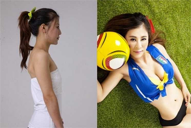 Biên tập tại một tạp chí ở Quảng Châu - Lu Ying cho thấy rõ nét sự khác biệt giữa trước và sau phẫu thuật thẩm mỹ. Cô gái 30 tuổi năng ngực, làm mũi và cấy ghép vùng cằm.