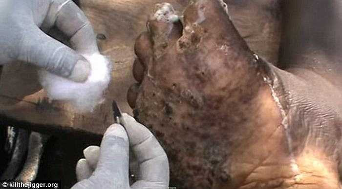 Các tổ chức y tế ở những vùng nhiễm bệnh đã khuyến khích người dân địa phương mang giày và vệ sinh sạch sẽ môi trường sống để ngăn chặn loài ký sinh. 