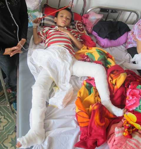 Bi kịch gia đình cha dùng rơm đốt con gây bỏng nặng