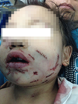 Chó tấn công bé 8 tuổi trông thương tâm thế này