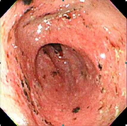 Giúp dân công sở thoát nỗi ám ảnh viêm loét dạ dày