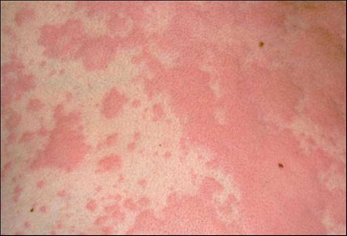 Tocopheryl acetate được gọi là vitamin E acetate. Nó được tìm thấy trong nhiều sản phẩm bao gồm cả son môi. Mặc dù không rơi vào nhóm nguy hiểm cao nhưng lại dễ gây ra phản ứng như nóng rát, ngứa, phồng rộp da, làm to lỗ chân lông... 