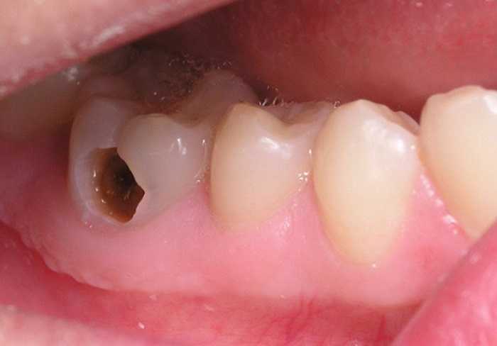 Paraphin cũng có một lượng nhỏ, nhưng thường xuyên sử dụng có thể gây hại cho men răng và gây sâu răng.