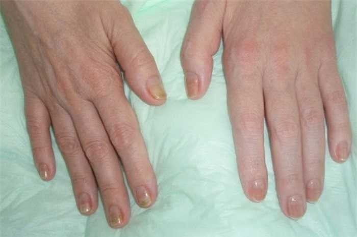 Phát hiện móng khô sần: Khi thấy móng không còn mịn, bóng mà lại có biểu hiện khô, sần sùi và bong tróc, tình trạng này báo động rằng móng của bạn có thể bị nấm, và cũng có thể tuyến giáp của bạn có vấn đề. 