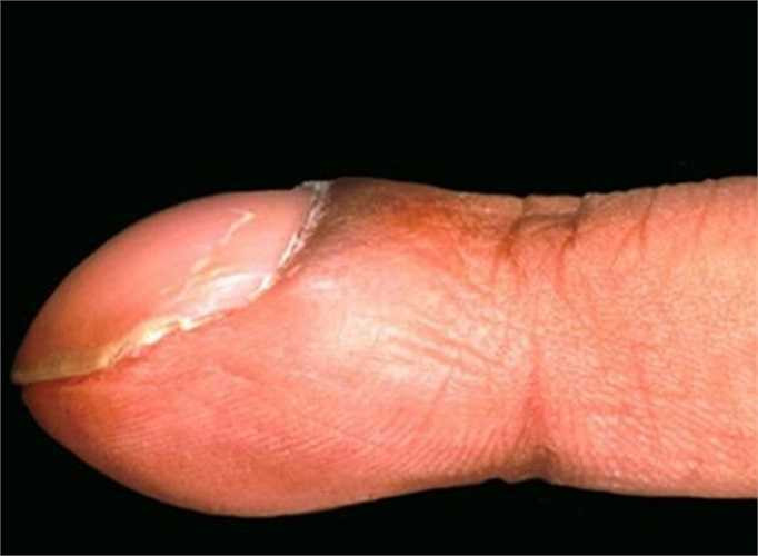 Móng tay dùi trống: Móng tay tròn vo giống như mặt sau của một chiếc muỗng có nhiều nguyên nhân như viêm nhiễm mãn tính, nhất là apxe, ung thư phổi, bệnh phổi mãn tính, bệnh lao lâu ngày không khỏi, hay bệnh tim bẩm sinh.