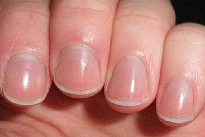 Chân móng tay của bạn có một hình bán nguyệt? Đó là hiện tượng bình thường. Nhưng khi tuyến yên của bạn có vấn đề hình bán nguyệt này sẽ biến mất. Còn chân móng hoàn toàn trắng là do biến chứng ở gan, thường gặp ở viêm gan.