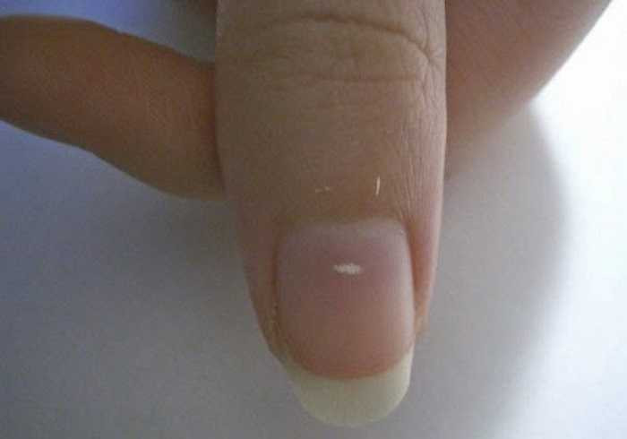 Móng xuất hiện hạt gạo: Những hạt gạo trắng trắng bé xíu xuất hiện trên móng đó là dấu hiệu cho bạn biết rằng chiếc móng đó đang bị tổn thương. Hoặc còn có một nguyên nhân khác nữa là rất có thể cơ thể của bạn đang bị thiếu kẽm.