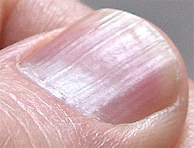 Khi quan sát, bạn thấy ở giữa móng bị lõm, 4 chung quanh vênh lên đến nỗi bạn có thể đổ một giọt nước vào giữa móng tay mà vẫn giữ được. Vấn đề này có thể liên quan đến tình trạng thiếu máu do thiếu sắt, suy giáp hoặc bệnh gan.