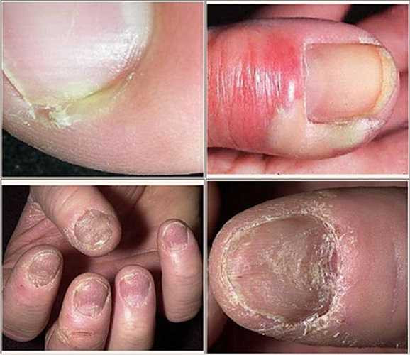 Khi móng tay trở nên lỏng và dễ lung lay, đó có thể là do bị thương hay viêm, cũng có thể là do các bệnh về tuyến giáp, bệnh vẩy nến, tuần hoàn kém hoặc do dị ứng phản ứng với thuốc. 