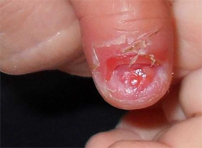 Vệt đỏ hoặc nâu nằm dưới móng tay: Đây thường là những dòng máu do mạch máu bị hư hỏng nhỏ và được gọi là mảng xuất huyết. Điều này không có gì phải lo lắng, nhưng nếu nhiều móng tay bị ảnh hưởng, nó có thể là dấu hiệu của một căn bệnh tiềm ẩn.