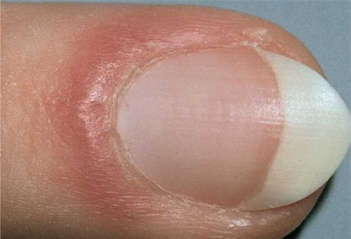 Sưng phồng da bao quanh móng: Nó có thể là kết quả của bệnh lupus (biểu hiện bằng các sợi mỏng, sừng hoá và teo đét ở mặt và các vùng da hở), hoặc là sự rối loạn các liên kết mô tế bào.