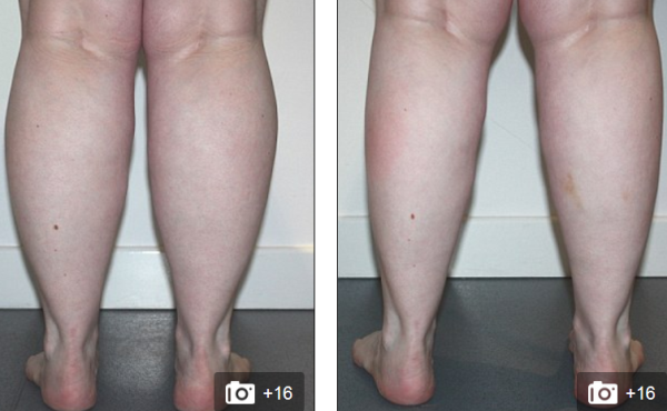 nở rộ mốt phẫu thuật thẩm mỹ bắp chân