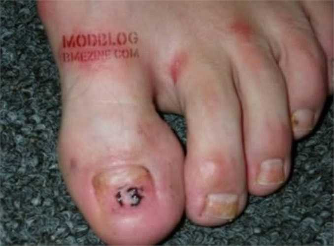 Xăm hình dưới móng chân. 