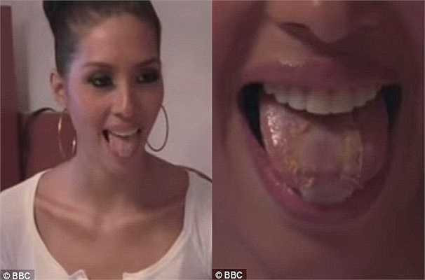 Thành công của các cô gái tại đây đôi khi trả giá bằng những nỗi đau kinh hoàng. Trong ảnh là một cô gái được khâu một miếng lưới nhựa vào lưỡi trong nỗ lực giảm cân và giữ dáng.