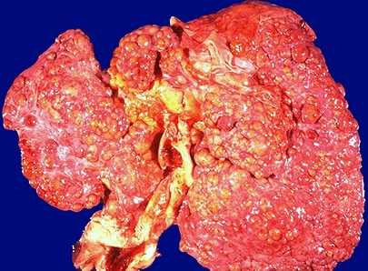 Tại sao người Việt 'chết mòn' vì ung thư?