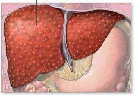 Viêm gan B virus: Nếu xét nghiệm sớm, 16 triệu người thoát cửa tử