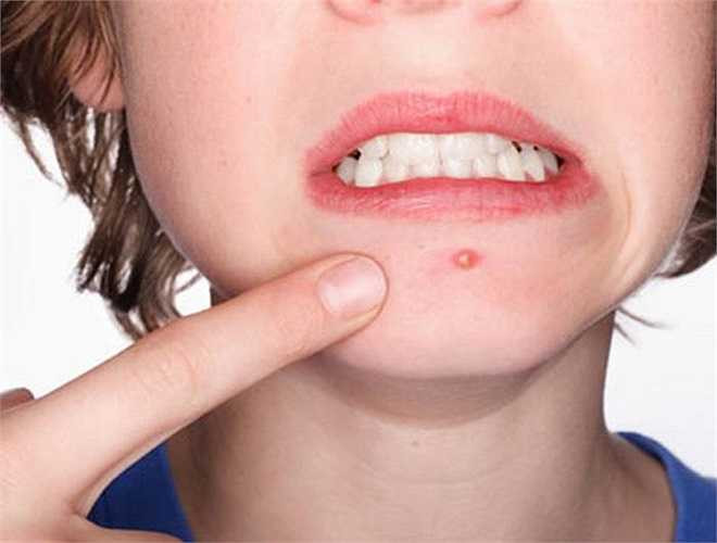 Chữa mụn nhọt: Hoa hồng bạch (20g) rửa sạch, giã nát đắp lên mụn, làm vài lần mụn sẽ giảm sưng và tiêu. 