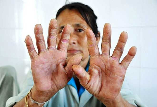 Quảng Ngãi: 'Bệnh lạ' tái xuất