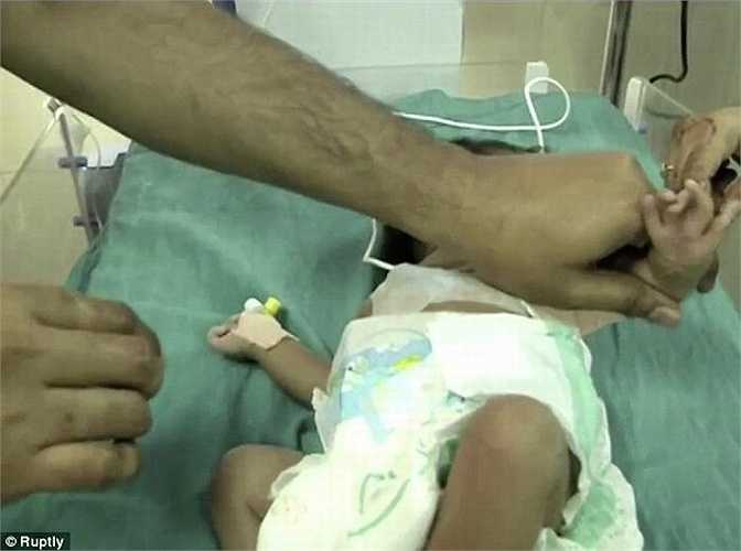 Hiện có rất ít trường hợp mắc Polymelia được biết trên thế giới. 