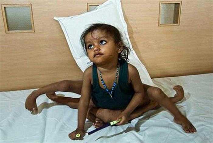 Bé Lakshmi Tatma, người Ấn Độ sinh ra với 8 chi. Năm 2007, các bác sỹ đã tiến hành cắt bỏ những chi thừa này cho cô bé.