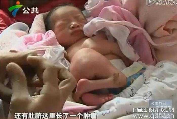 Một bé trai sơ sinh chào đời tại bệnh viện Nhân dân Huệ Đông, Trung Quốc có 4 chân, 4 tay, một cặp chân tay thừa mọc trên bụng. 